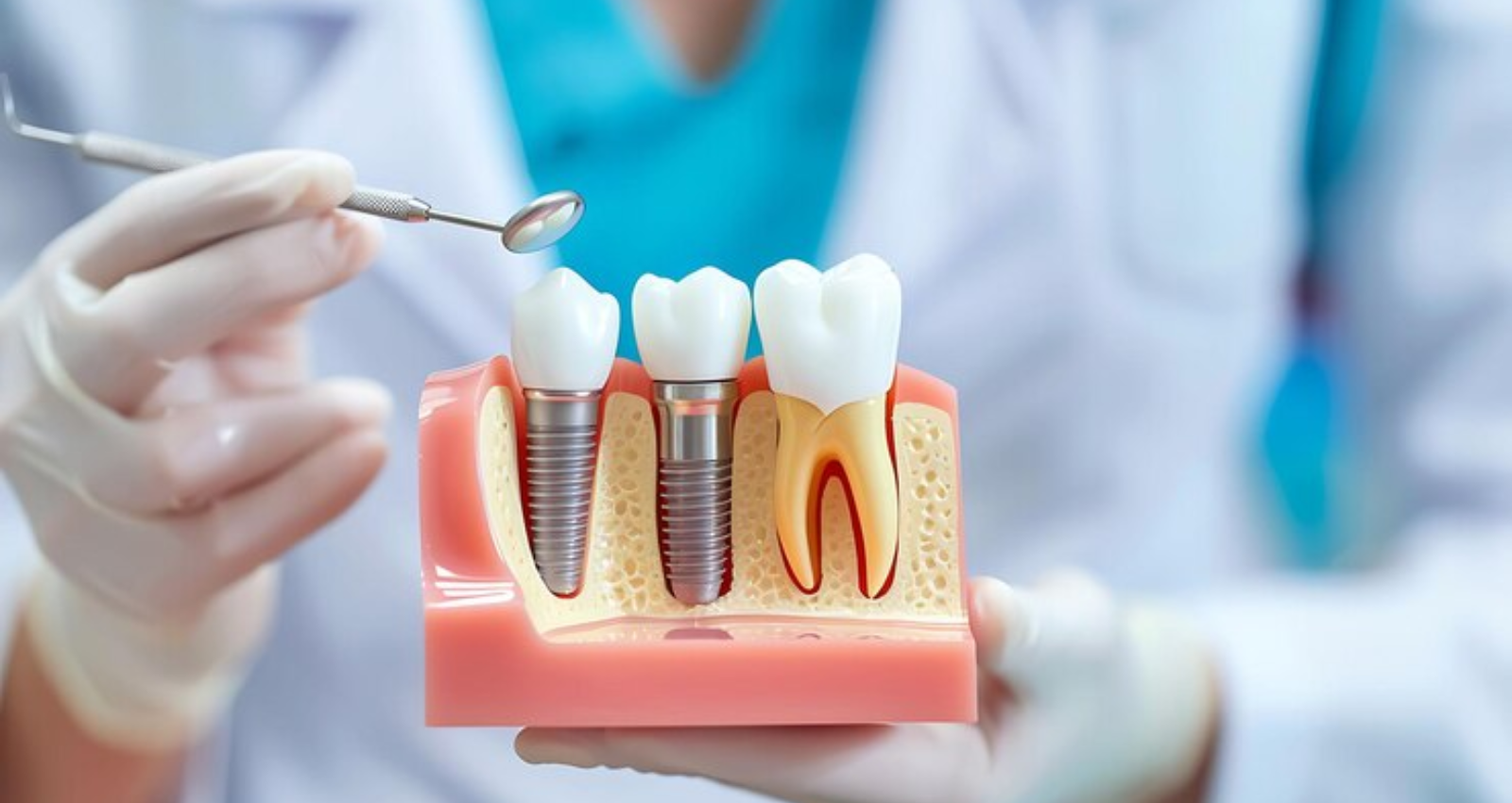 how long should you rest after dental implant surgery